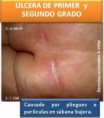 /album/fotogaleria/foto-4-ulceras-grado-ii-iii-causado-por-pliegues-jpg/